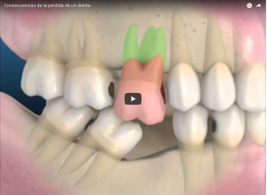 perdida de dientes