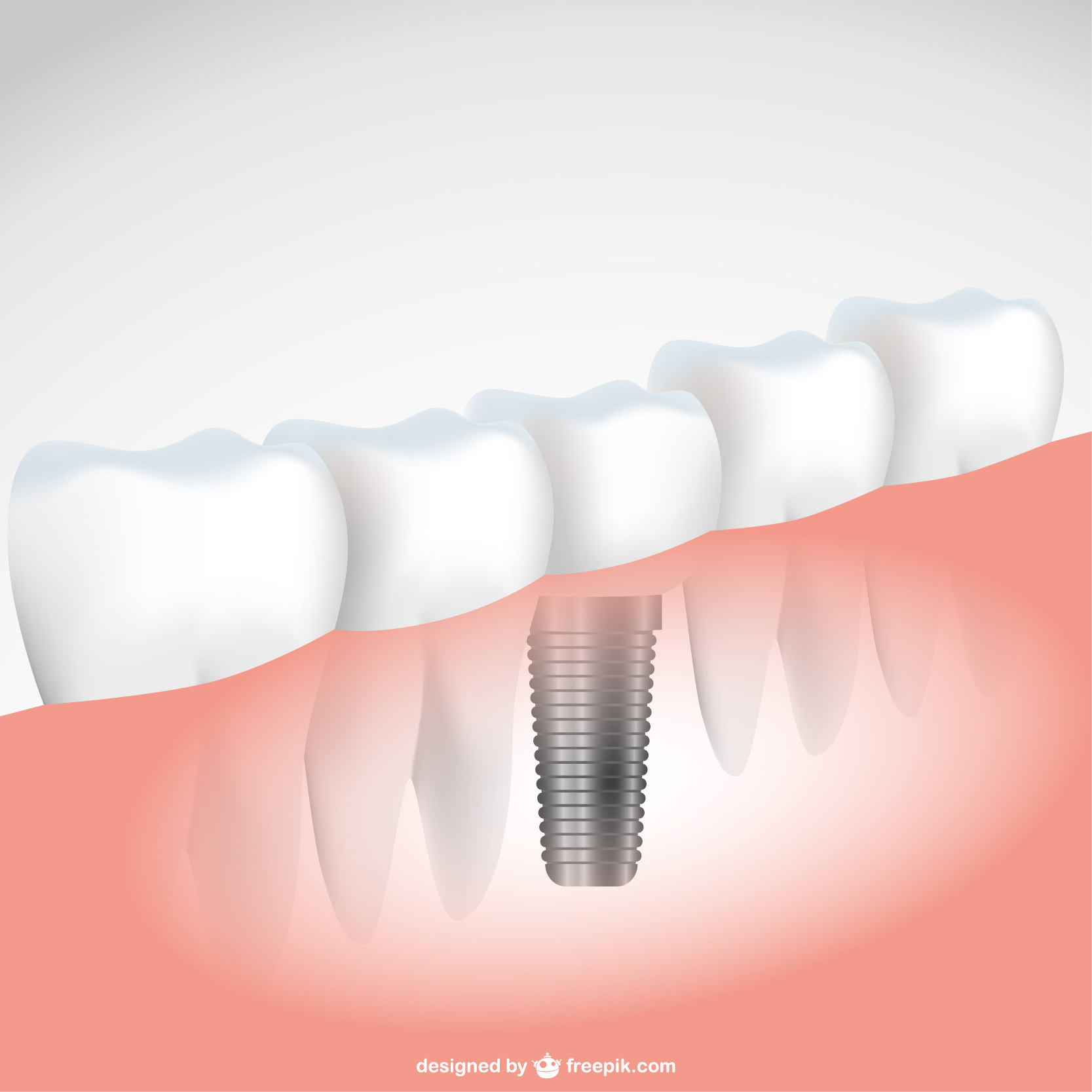 implantes dentales estetica dental odontologia odontólogo dentista