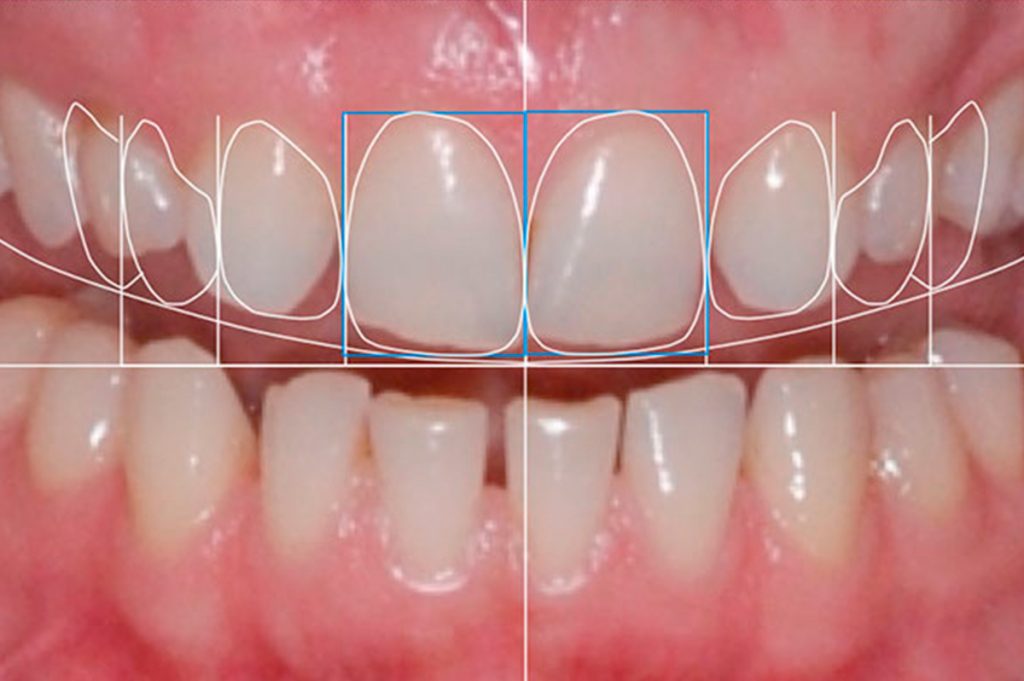 diseno-de-sonrisa odontologia 
