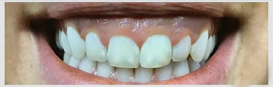 gingivoplastia diseño sonrisa
