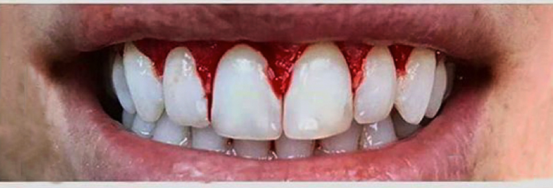 gingivoplastia diseño sonrisa