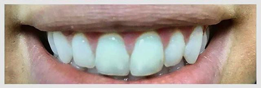 gingivoplastia diseño sonrisa