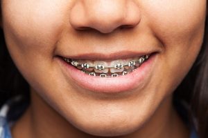 ortodoncia brakets frenos odontologo dentista