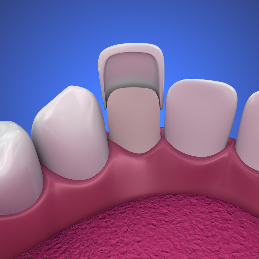 Carillas Dentales, Odontología, Estética Dental