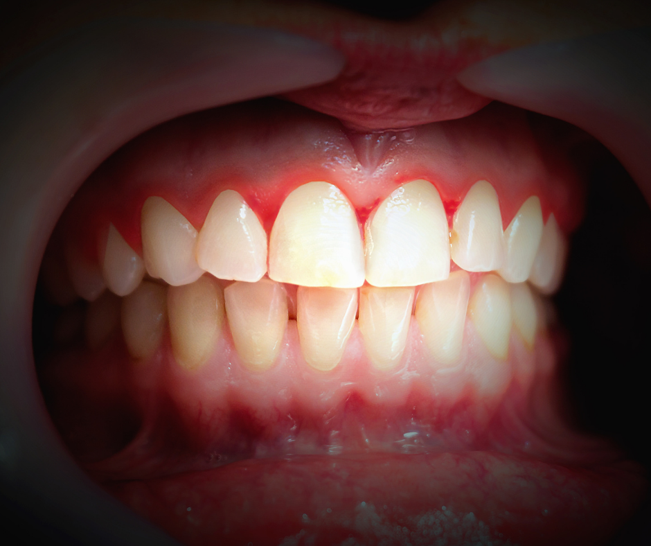gingivitis, odontología, embarazo