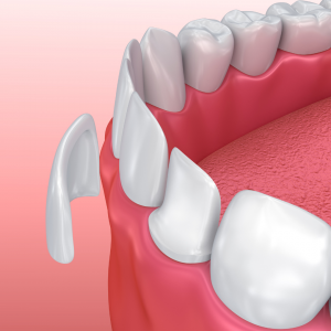 Carillas Dentales, Odontología, Estética Dental