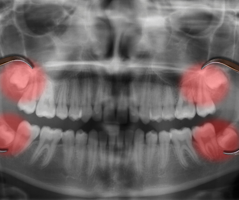 Terceros Molares, dientes apiñados, muelas del juicio