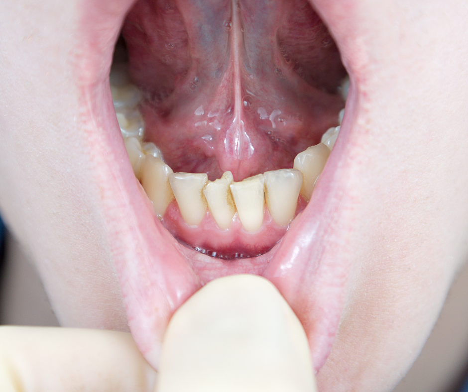 Terceros Molares, dientes apiñados, muelas del juicio