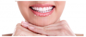 estética dental, diseño de sonrisa